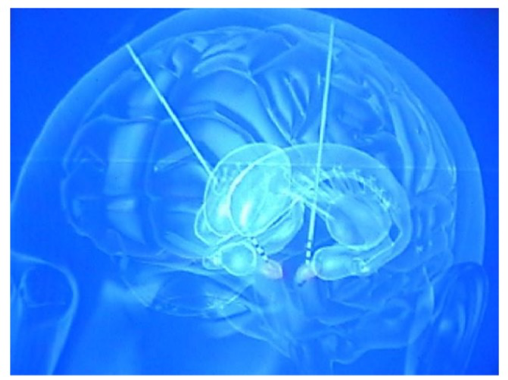 deep brain stimulation