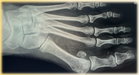 Røntgenbilde av fot